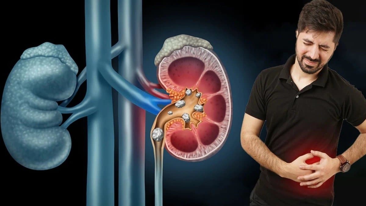 New tiny Magnetic Robot breaks down kidney stones faster with no pain