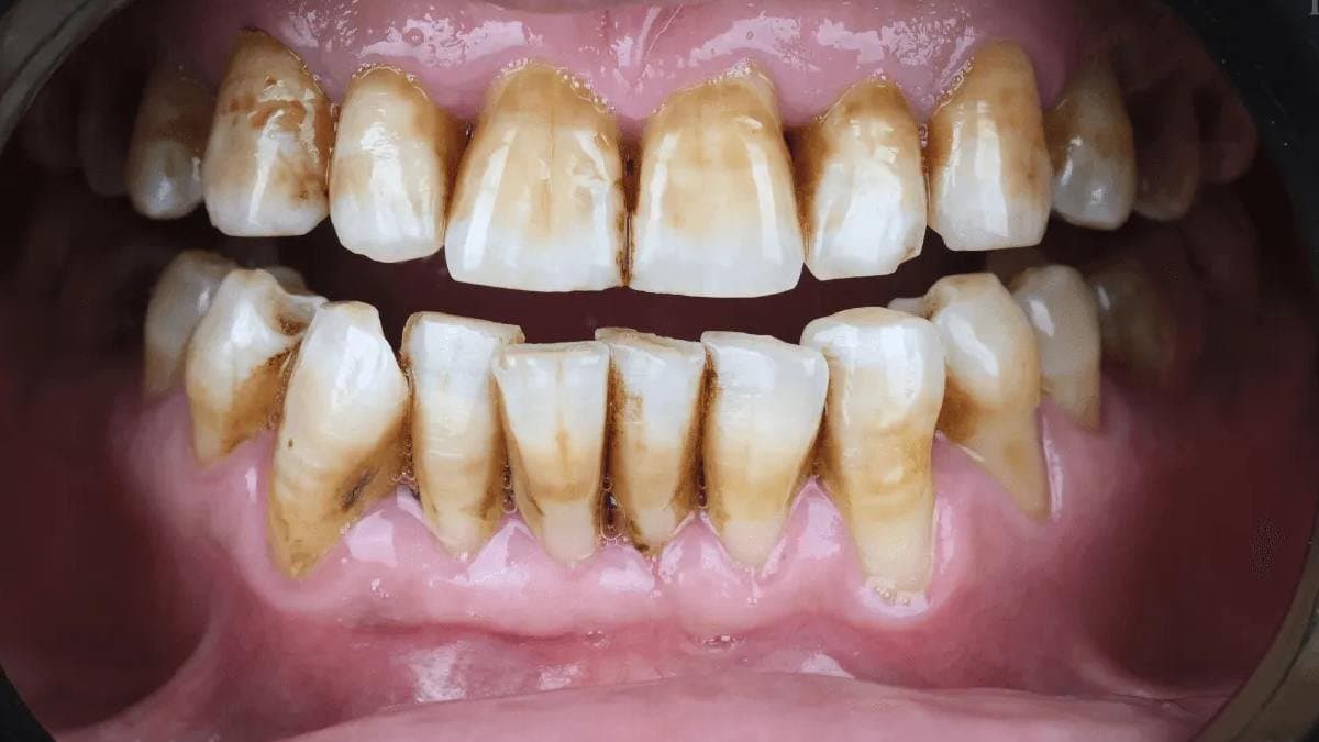 Brushing error among top reasons of gum problem
