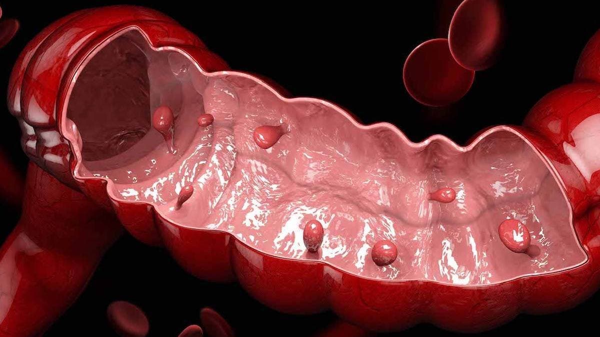 Yogurt may help to reduce Colon Cancer risk says study