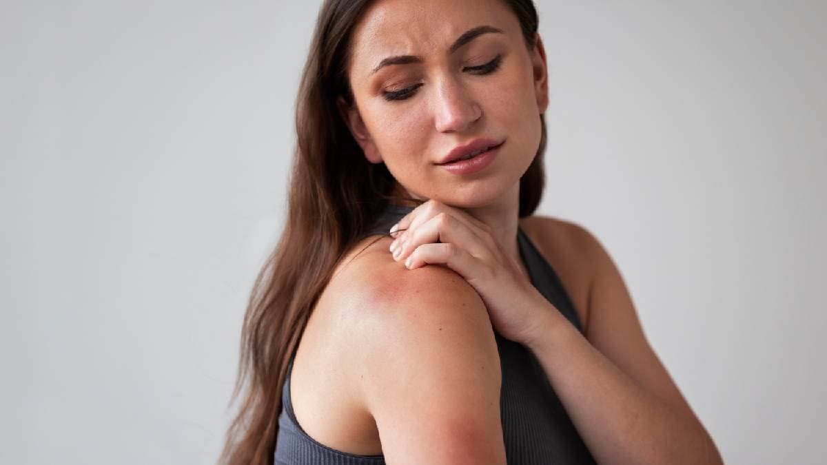 Neem and Aloe vera gel among home remedies of Prickly Heat and Summer Rash