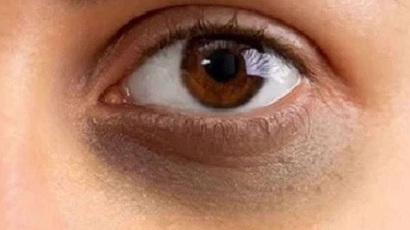What can be the causes of dark circle even after 8 hours sleep here is actual reasons  lif