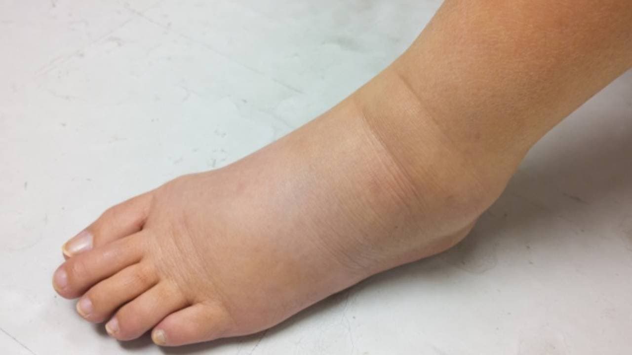 Health Tips: Swelling in legs is dangerous know the reason behind this symptoms