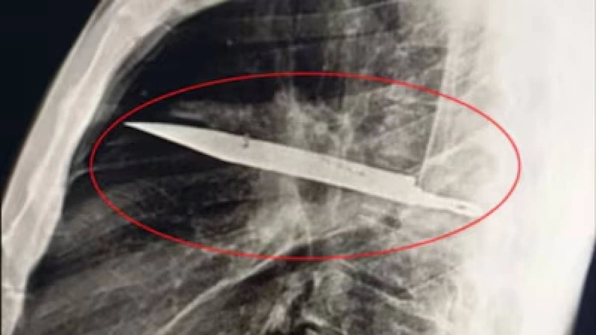  Mans Nipple Pain Reveals Knife Lodged In Chest For 8 Years