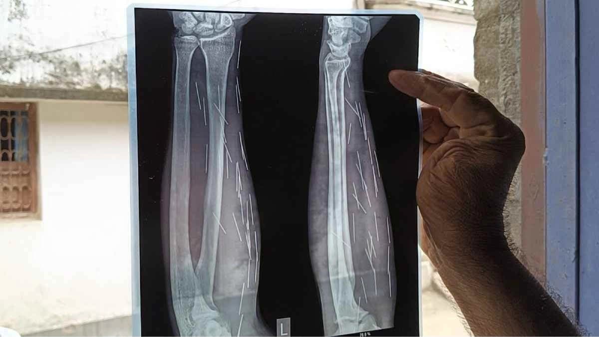 Youth found whose body is producing needles claim his wife and neighbours