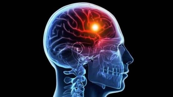 Why brain stroke are increasing in young age know the symptoms prevention and all details from doctor