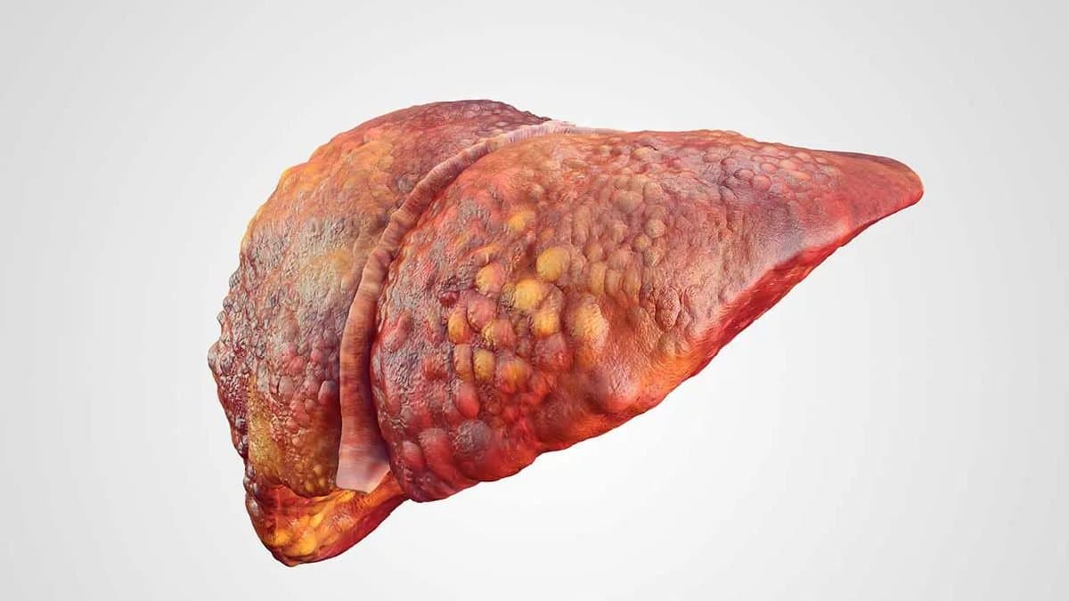 Liver damage symptoms: jaundice tiredness among top signs