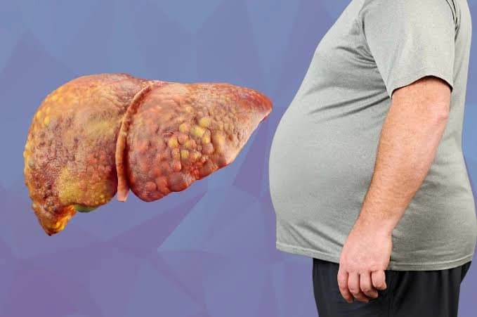 How to reduce fatty liver