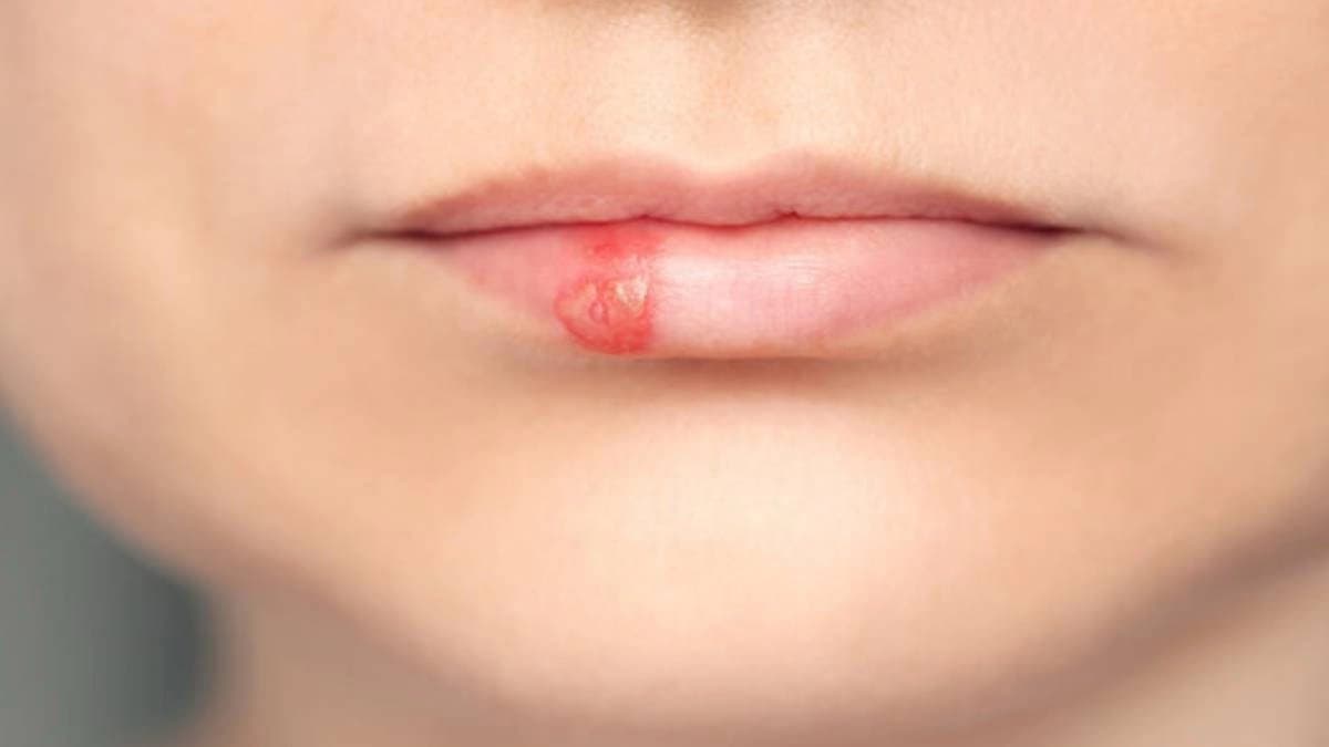 Herpes is a lifelong viral infection caused by unprotected intimacy