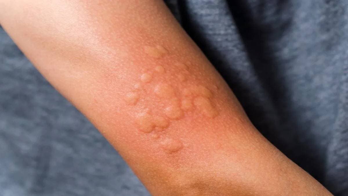 Urticaria rising as stress pollution and heat take their toll gnr