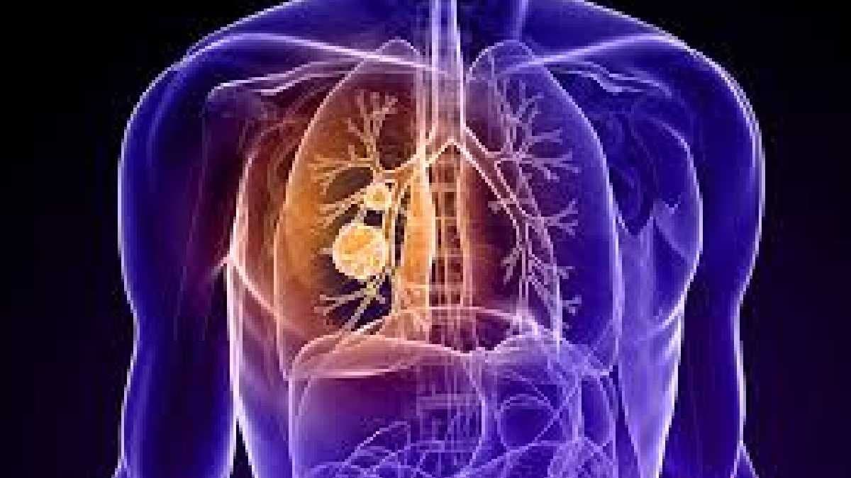 Lung cancer leading in never smokers on the rise gnr 