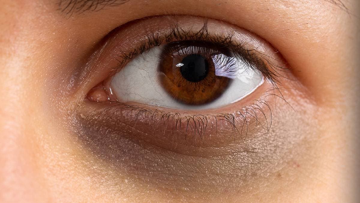Dirk circles of eyes can be a sign of deep lying issues