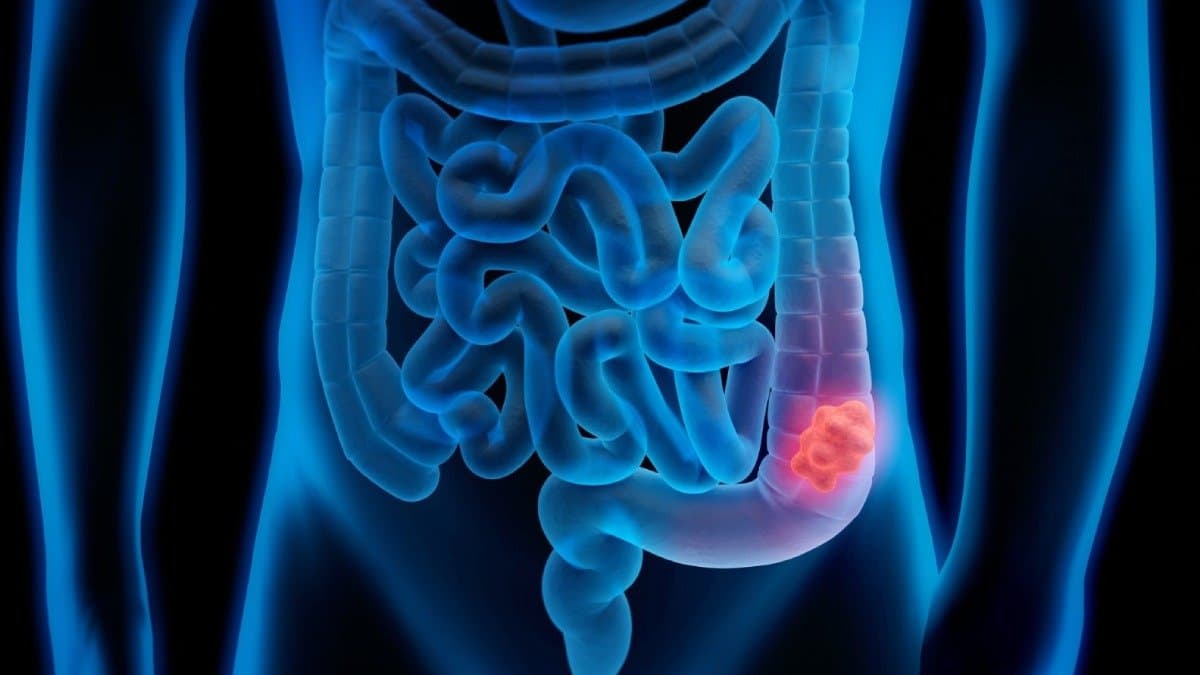 Health Tips: These symptoms of colon cancer should not be ignored