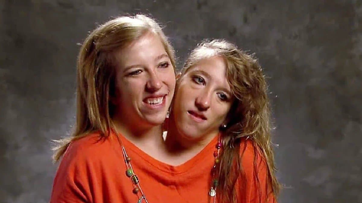 Rare condition: life of Conjoined twins could be very difficult but this twin is winning