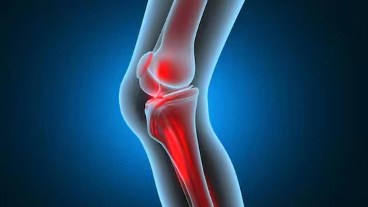 How to use bay leaves and garlic for joint pain