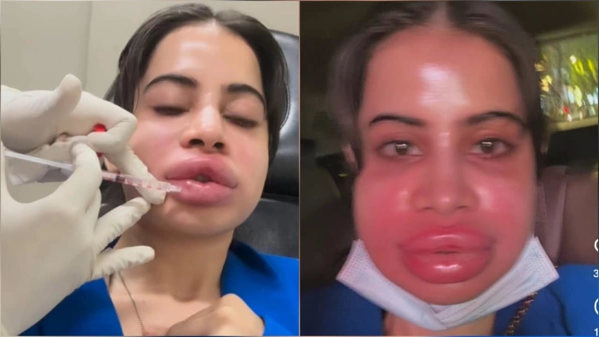 Urfi Javed undergoes her lip filter dissolve viral video