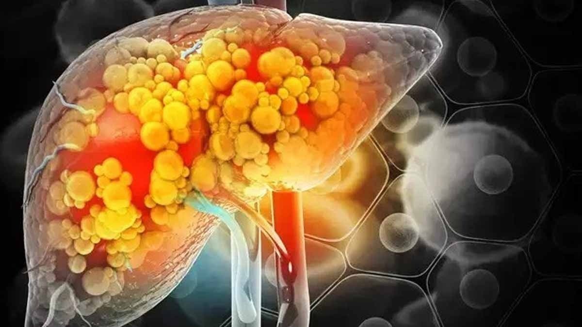 These everyday foods are more dangerous for your liver than sugar and alcohol 