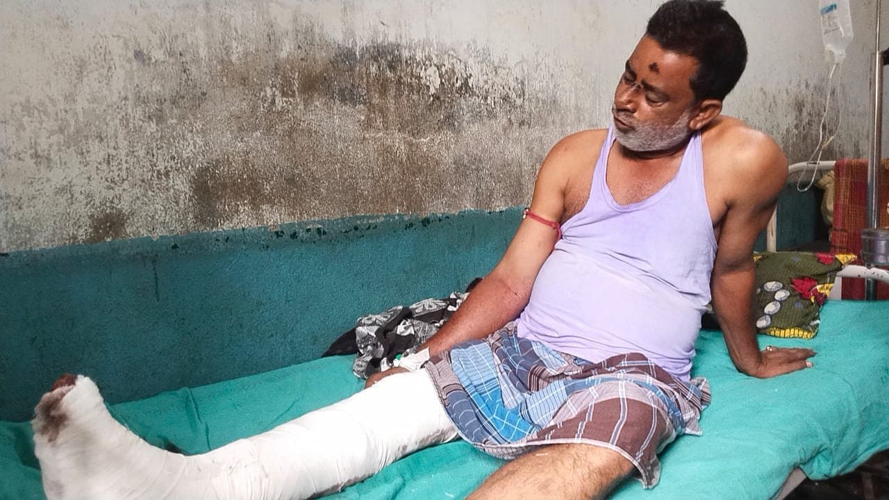 Operation : কান্দি মহকুমা হাসপাতালে পায়ের জটিল অপারেশন 