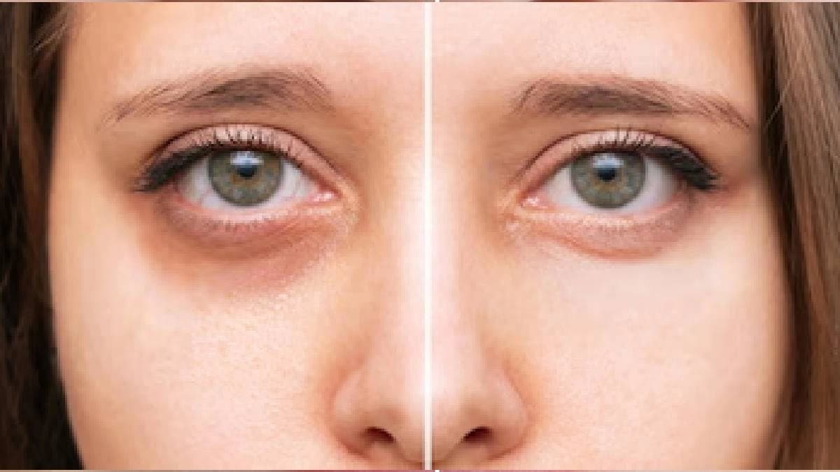 Skin care tips get rid of dark circles with home ingredients