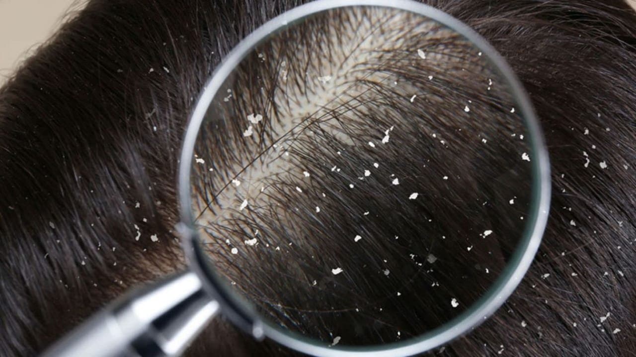 this Home made natural shampoo prevents dandruff and gives shine on hair lif