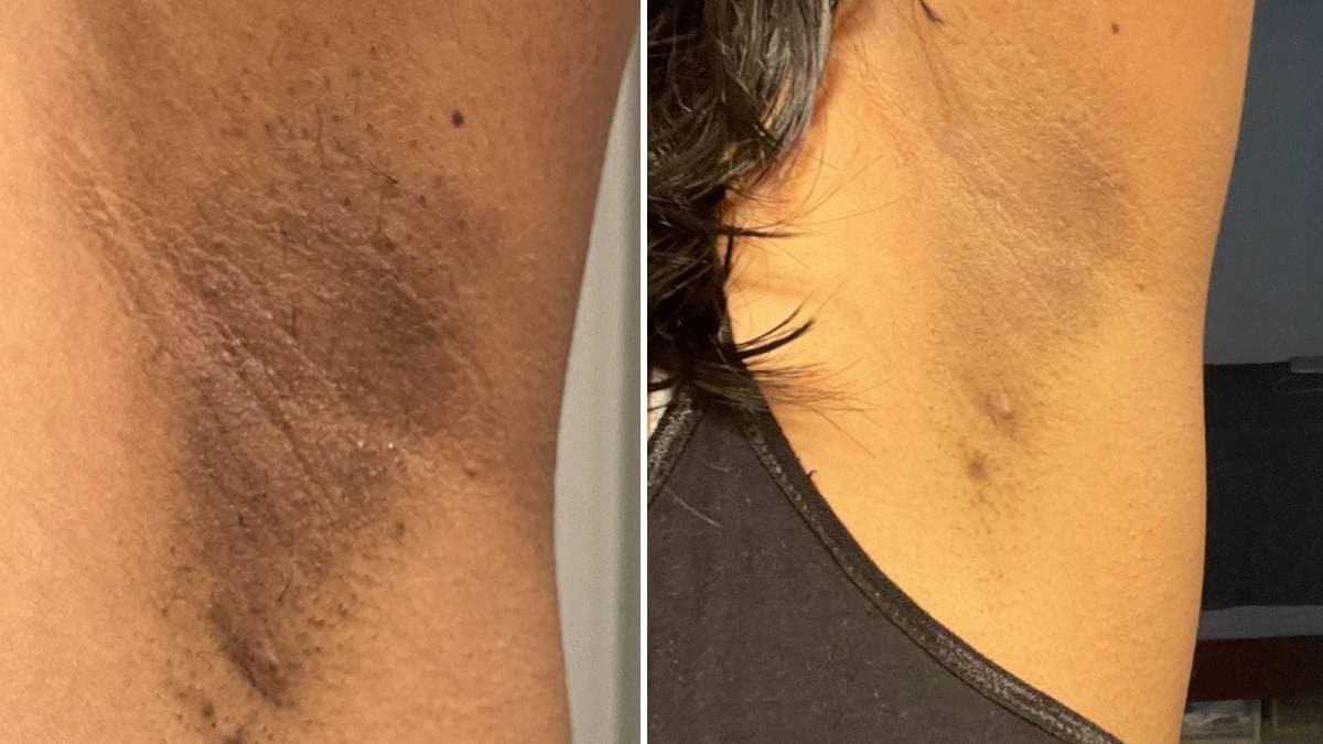 By these all tricks of home remedies can prevent dark spots of your underarms within one month lif