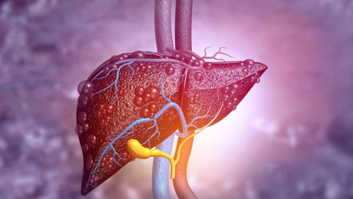 AIIMS trained liver specialist shares 3 drinks for patients with fatty liver disease