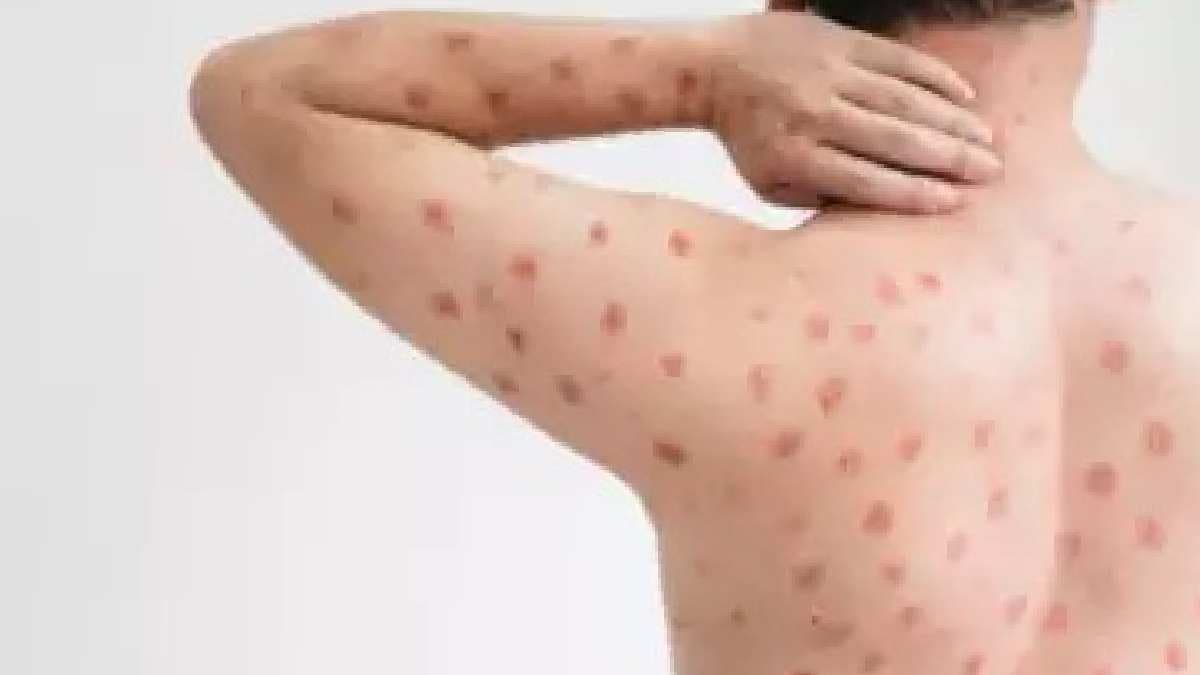 Researchers develop optical biosensor for rapid monkeypox detection gnr 