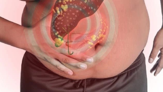 Fatty Liver Symptoms: these uncommon warning signs of fatty liver should not ignore