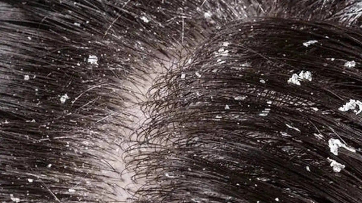 This home remedies help to get rid of dandruff 