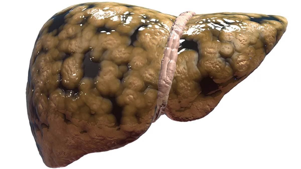 Seven Fatty Liver early symptopms can help cure Liver disease