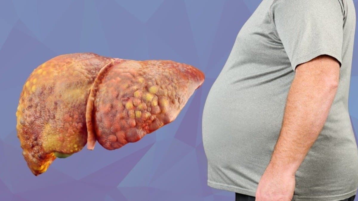 Fatty Liver Cleaning Tips: These easily available foods and spices cleanse your liver naturally