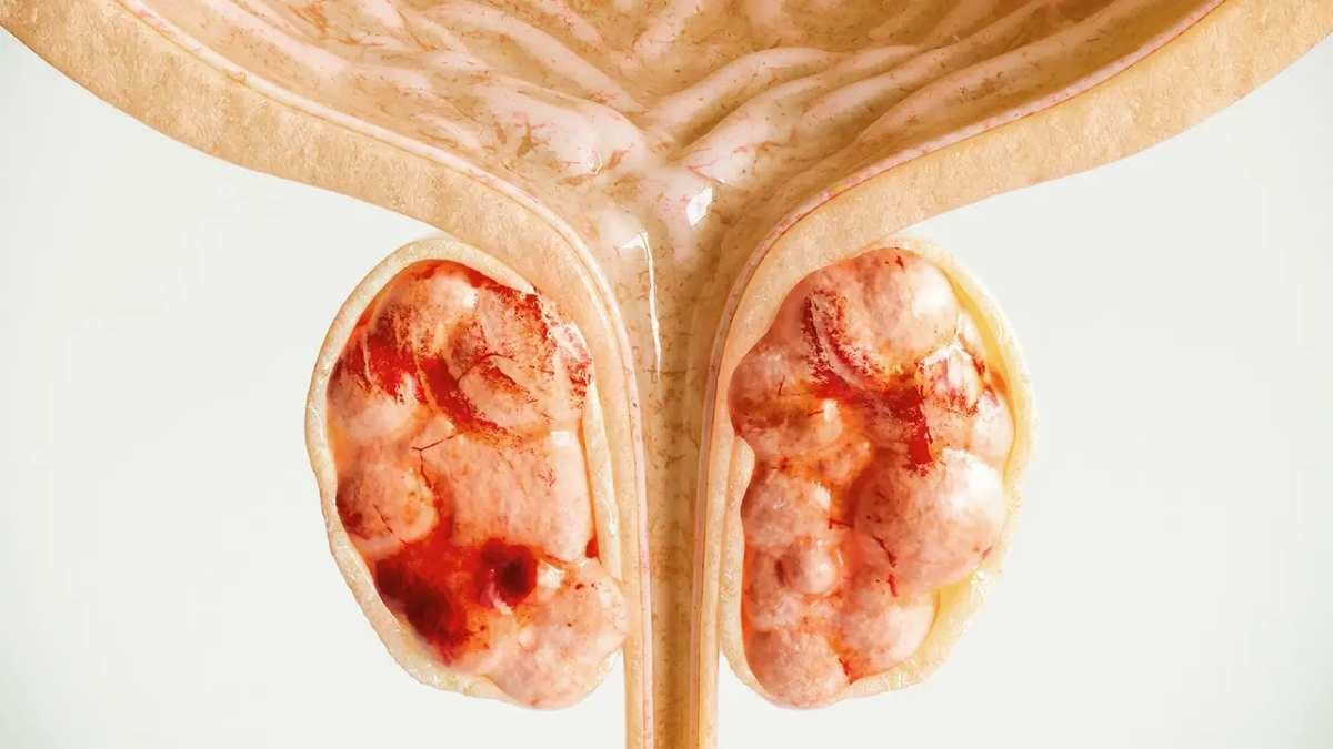 Red Meat and alcohol among top reasons of Prostate Cancer in men