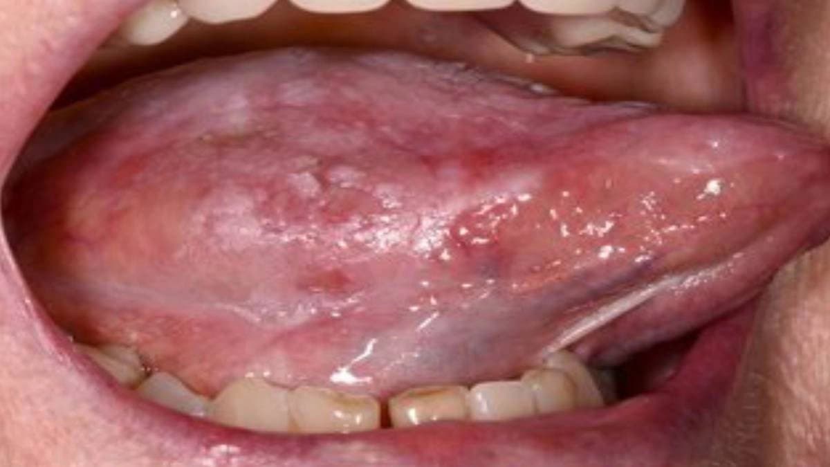 throat-cancer-oral-intimacy-symptom