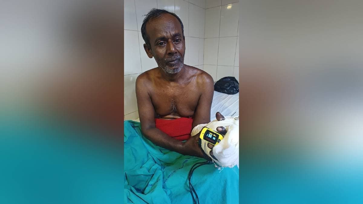 elderly mans severed hand succesfully joined after surgery at r g Kar hospital