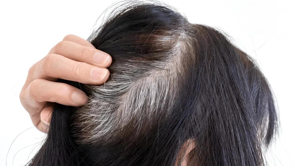 Use Amla and coconut oil to prevent gray hair