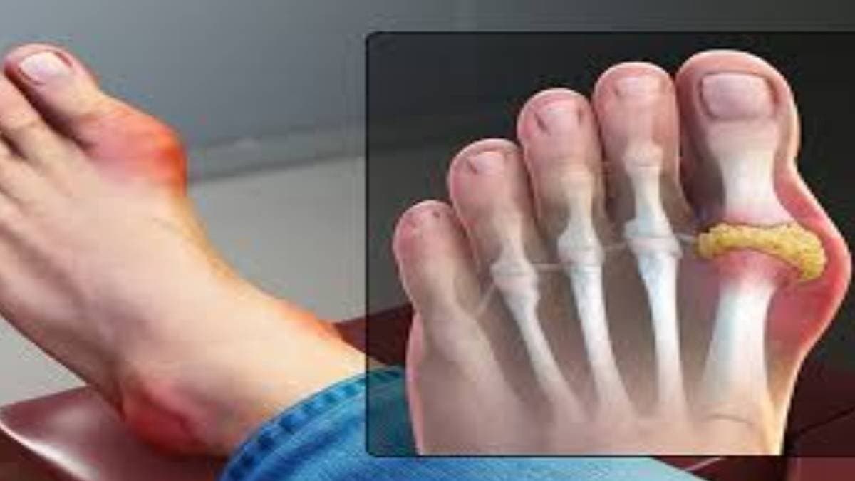 Tips to control uric acid