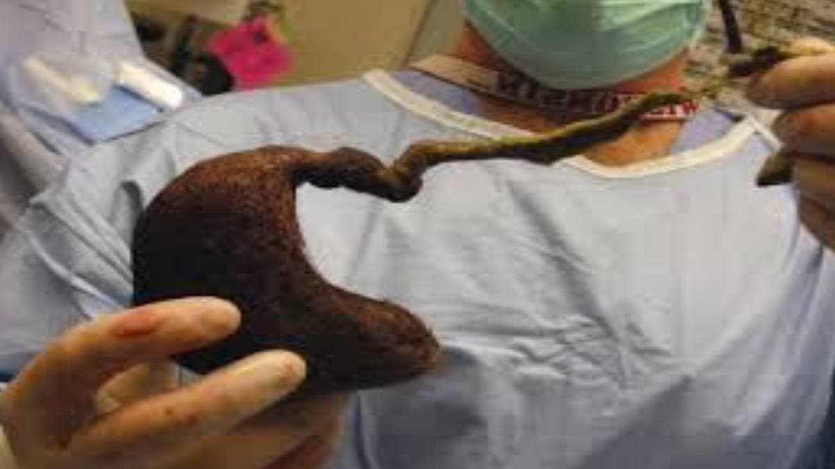 A 210-centimeter-long hair came out of this organ of the teenager