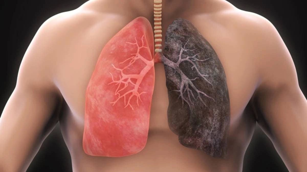 These are the silent Symptoms of Lung Cancer among Non Smokers