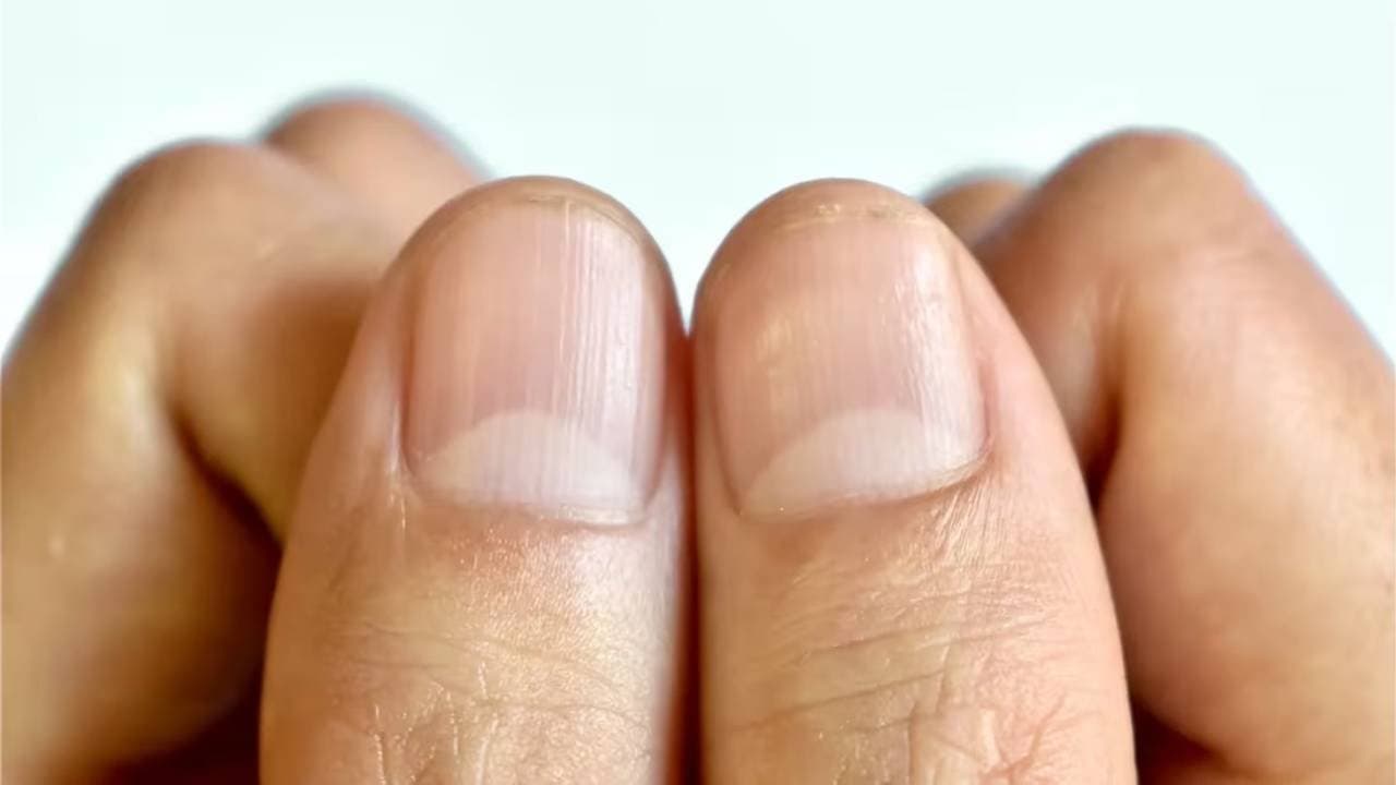 Is the formation of a half moon on the nail a symptom of heart or kidney disease