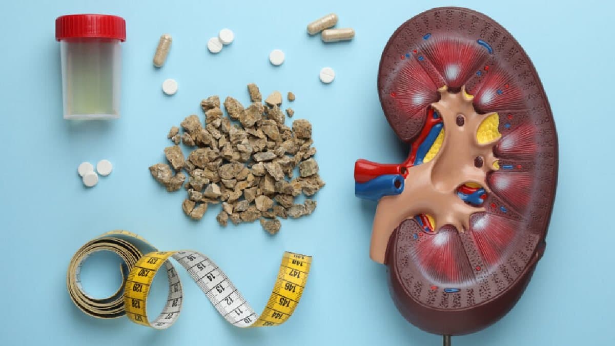These five symptoms can be caused by kidney stone