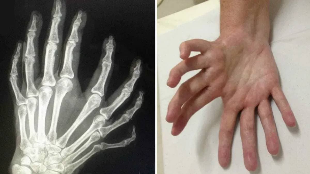 Mirror Hand Syndrome is a very rare Health Condition