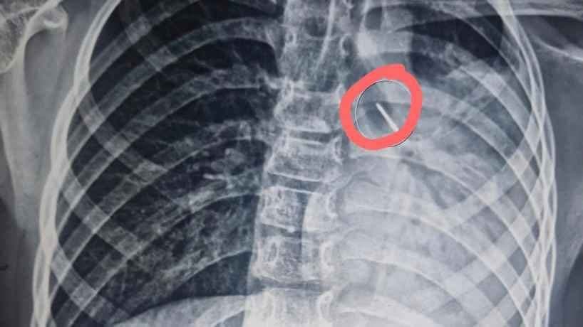 Kolkata Medical College saves life of a critically ailing boy