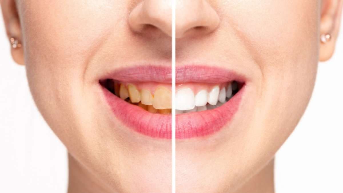 this home made natural remedy can prevent yellow shade of teeth prevent cavity and make your teeth strong and healthy lif 