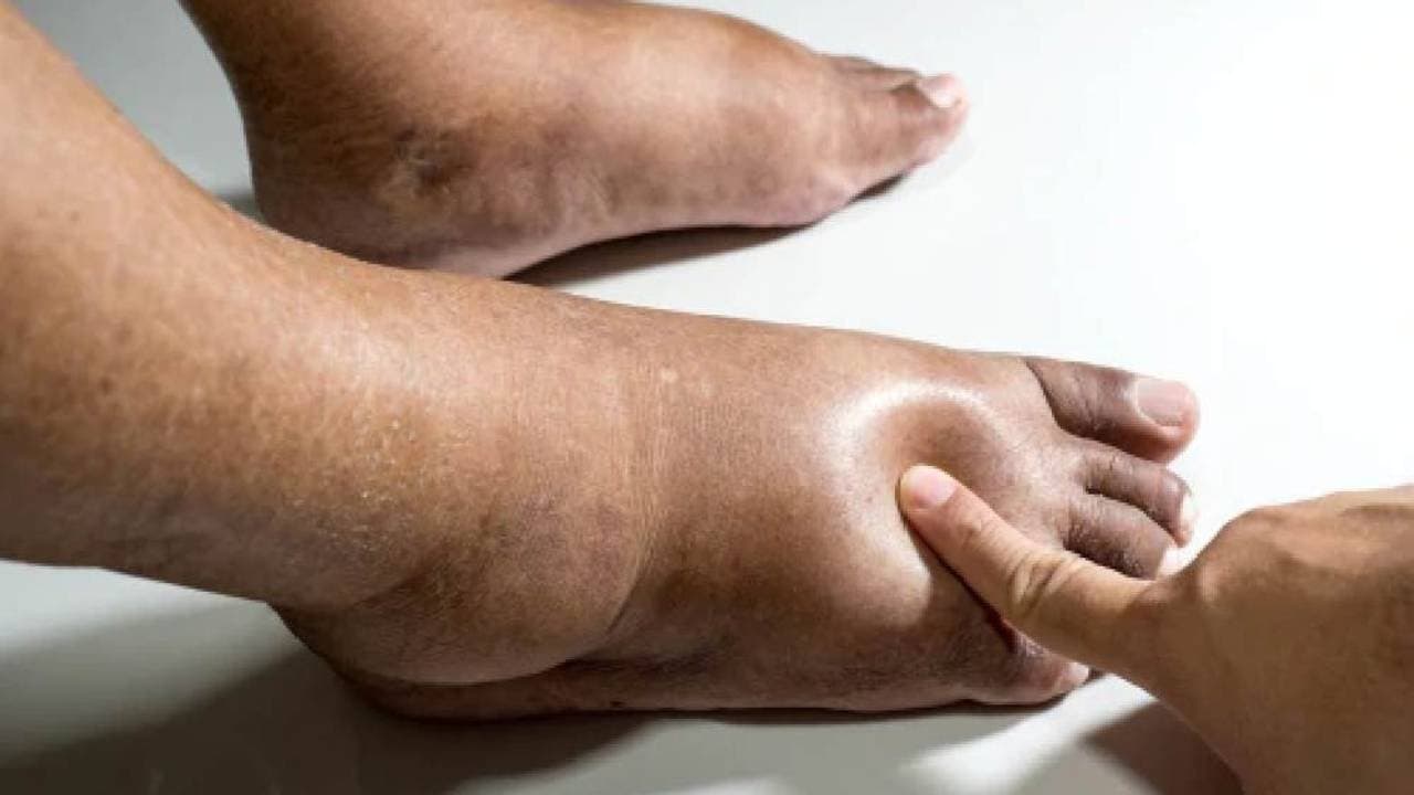 Health Tips: Swelling in legs indicate many critical health problems