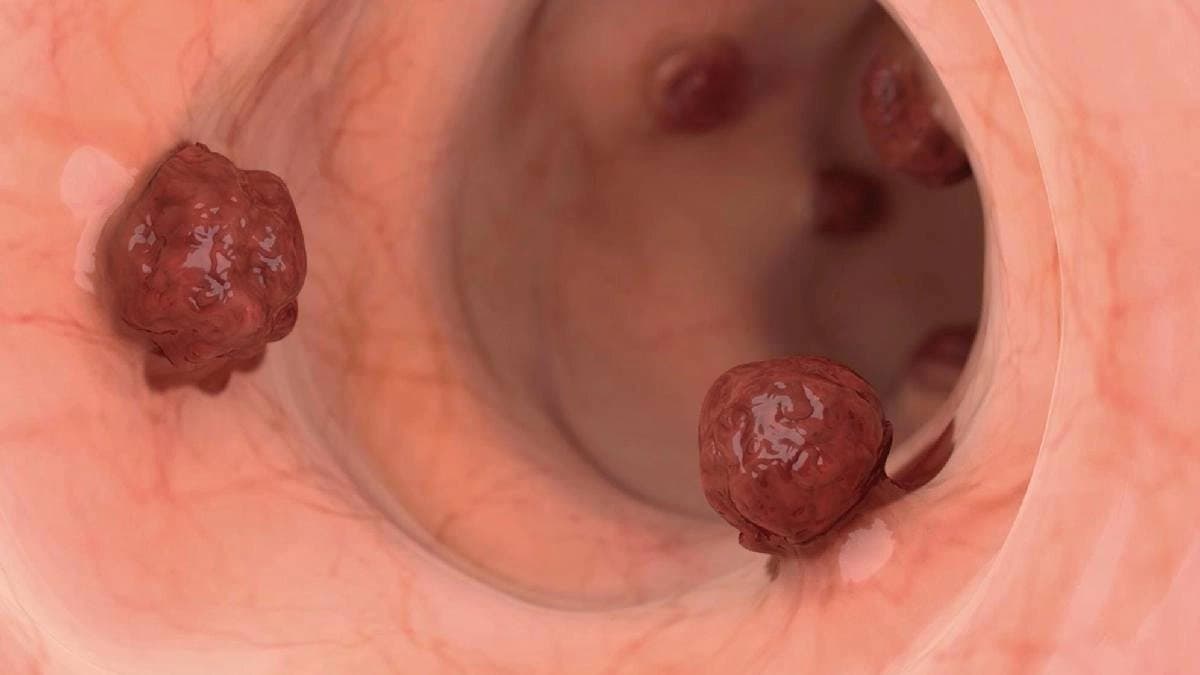 How to detect and prevent Colon Cancer