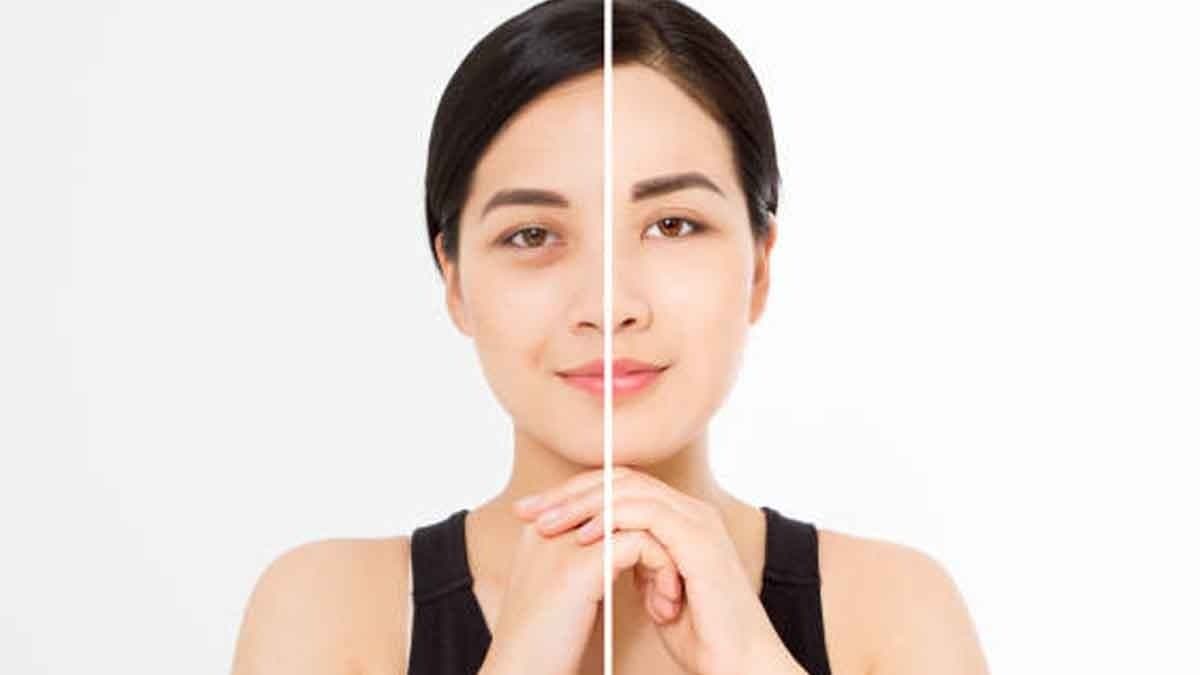 these all tricks can remove your under eye dark circles within seven days and make your eyes bright lif