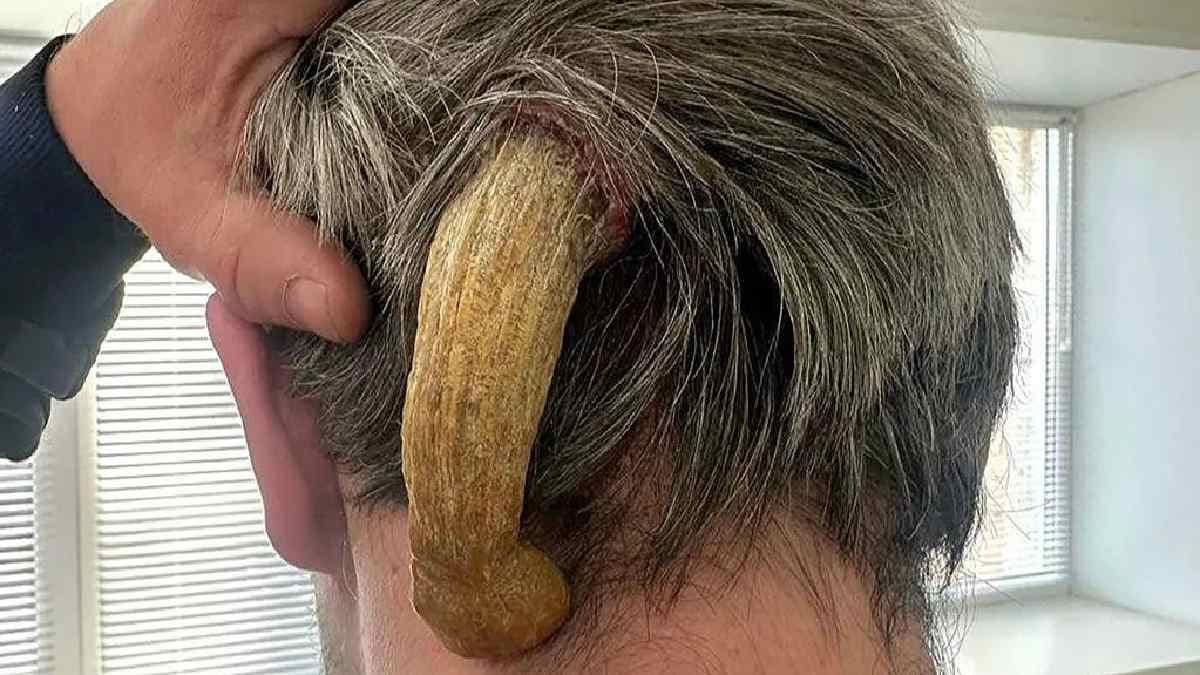 Fact Check: russian man suffered from bizarre five inch long horn on head