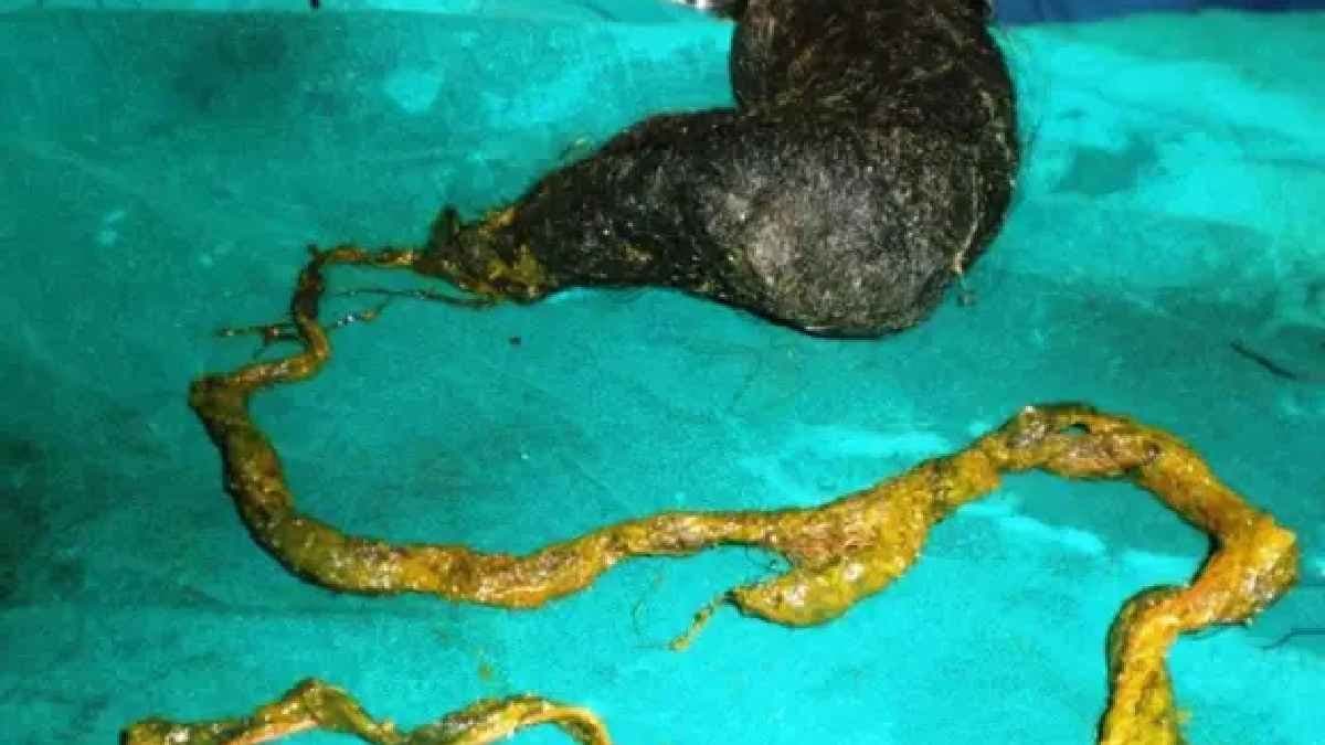 Doctors in Jaipur have successfully removed a 210 centimetre long hairball at girl stomach