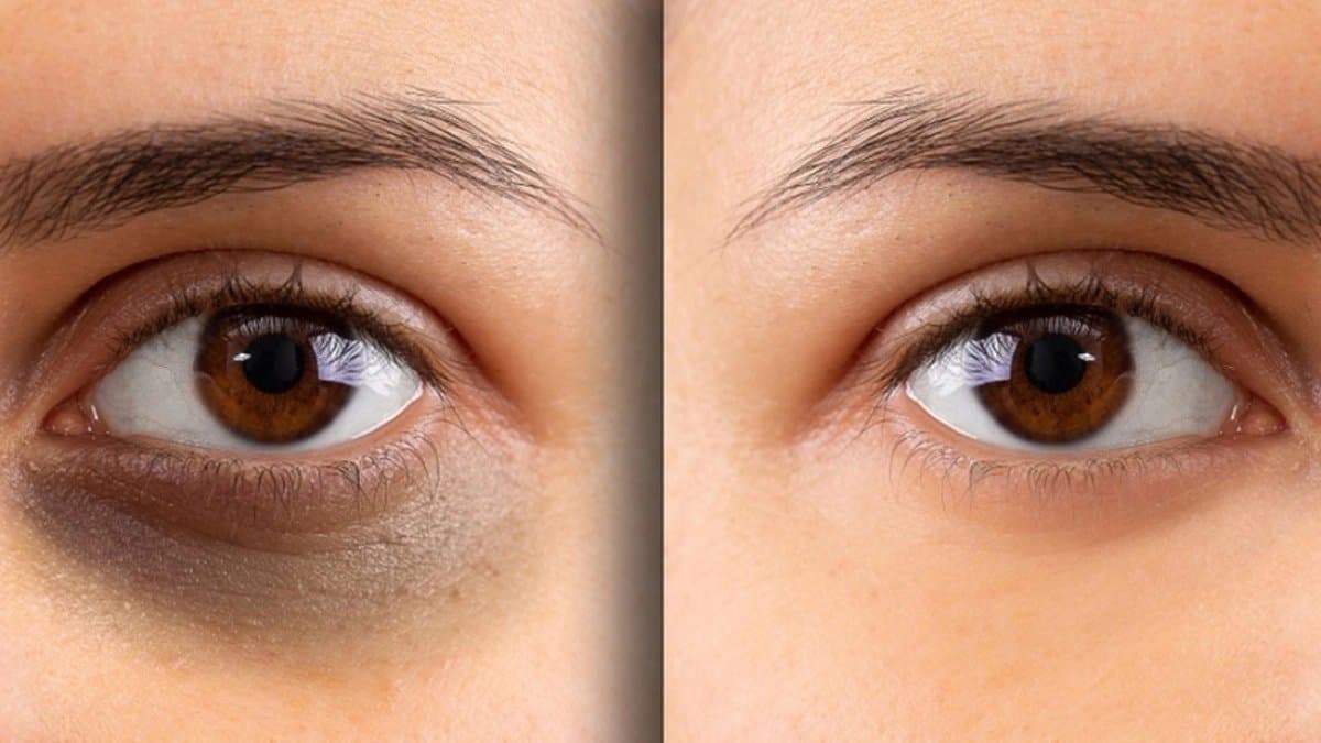 This home remedy gives you relief from dark circle problem 