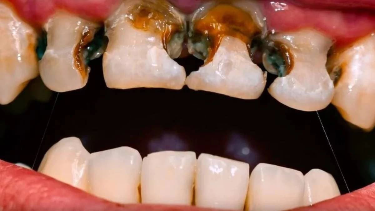 Sugar is not the only cause of tooth decay know what are the reasons of cavities without sweet