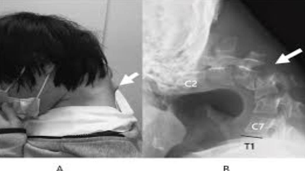 Dropped Head Syndrome experts concerns